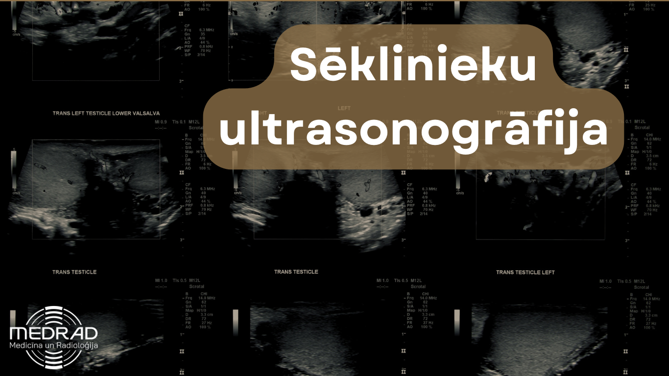Sēklinieku ultrasonogrāfijas attēls ar grafisku sēklinieku zīmējumu un virsrakstu "Sēklinieku ultrasonogrāfija"