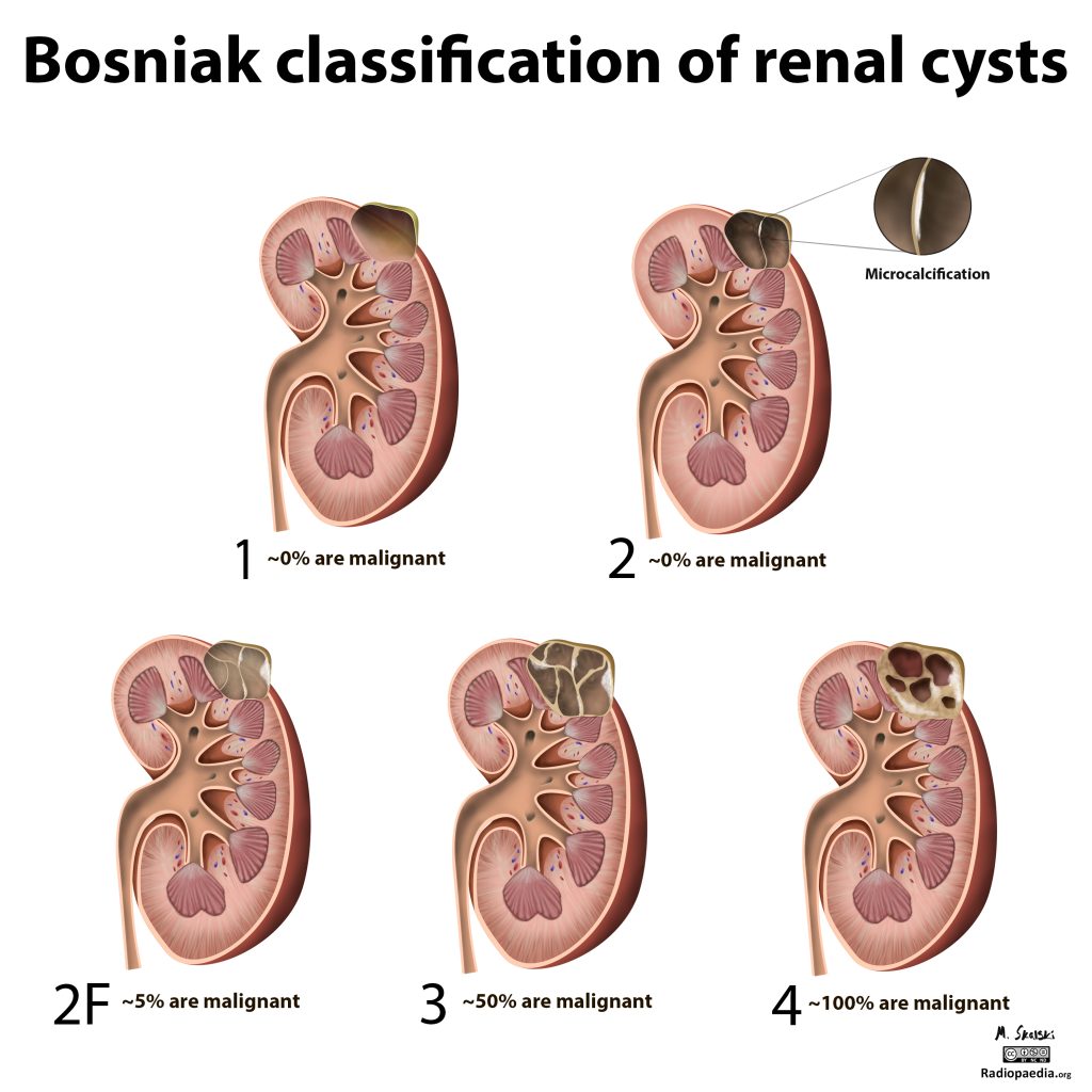 Nieru cistu Bosniak klasifikācija