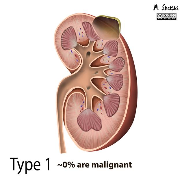 Nieres cista - Bosniak I