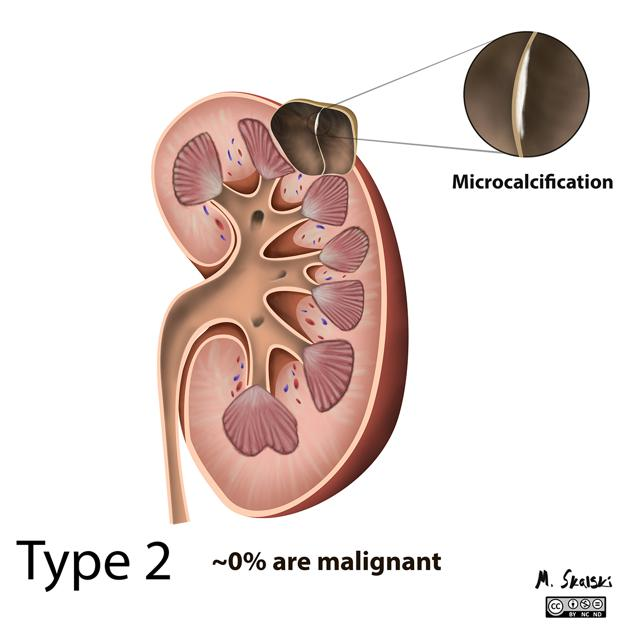Nieres cista - Bosniak II