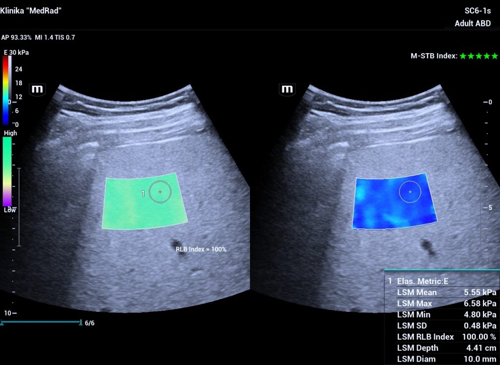 Aknu elastografijas merijumi