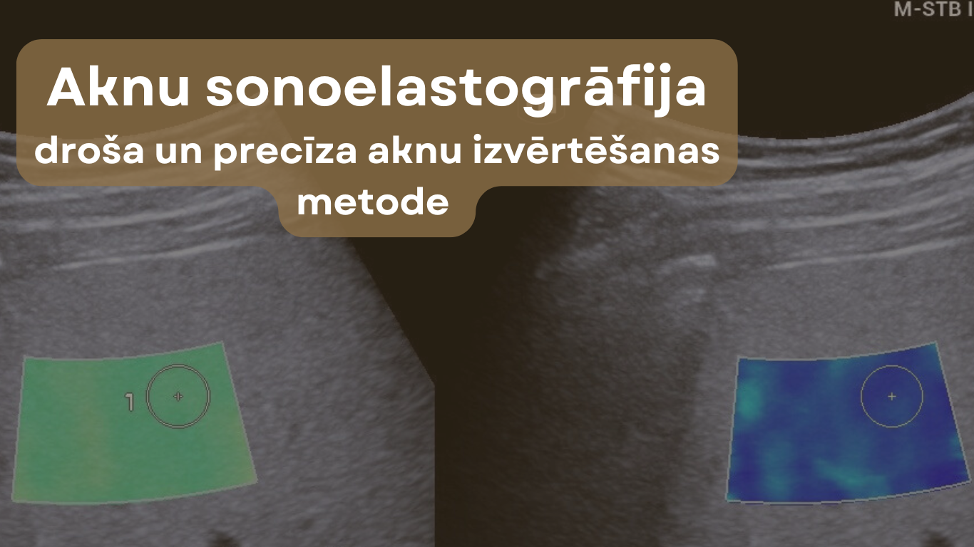 Ultrasonogrāfijas attēls ar aknu sonoelastogrāfijas mērījumu uz ekrāna
